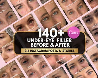 Under eye filler Before & After Instagram Post | sculptra Filler Canva Template Medspa, Nurse Injector, Face filler injection, dermal filler
