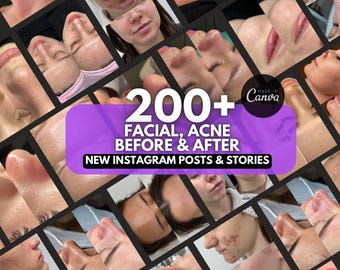 Facial posts, acne Treatment Instagram Templates | Hydrafacial Canva template | SkinCare Posts | Acne before and after, Esthetician post