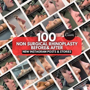 Icke-kirurgisk näsplastik före och efter, näsfyllning, ansiktsfyllningsinjektioner på Instagram, botox, läppfyllningscanva-mall, Medspa-inlägg