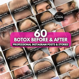 30 Botox Instagram posts | Botox before and after | Skincare | Botox canva template, Medspa social media, nurse injector instagram canva