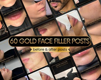 60 dermal filler Instagram posts | Face filler injection before and after, Lip filler canva template, Medspa social media, nurse gold post