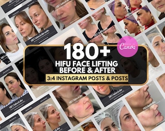 HIFU Before & After Photo Instagram Template | Nurse injector Canva template, botox and filler, Instagram Post for Ultrasound Facelift