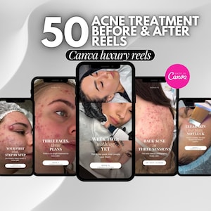May include: A digital display of 50 acne treatment before and after reels templates for Canva. The graphic features five smartphone screens showing skin care progress photos, text overlays, and a pink circular badge that reads Made in Canva.