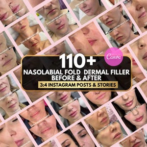 ghk-cu nasolabial folds BPC-157/TB-500 Blend