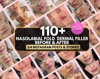 Dermal Filler Before & After Instagram Post | Nasolabial Fold Filler Canva Template Medspa,Nurse Injector, Face filler injection, smile line