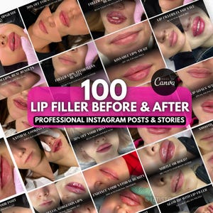 以下が含まれることがあります： 唇のフィラー治療を紹介する画像のコラージュで、ビフォーアフターの写真が特徴です。中央のテキストは「100 Lip Filler Before & After Professional Instagram Posts & Stories」と書かれています。さまざまなプロモーションテキストも表示されています。