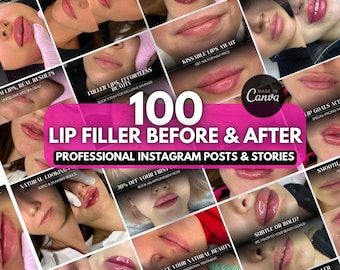 100 Lip filler Instagram posts | Lip injection before and after | Skincare | Lip filler canva template, Medspa social media, nurse injector