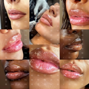 Lip filler stock photo, nurse injector stock photos, stock photos medspa, lip filler instagram photo, Botox photos, micro filler photos