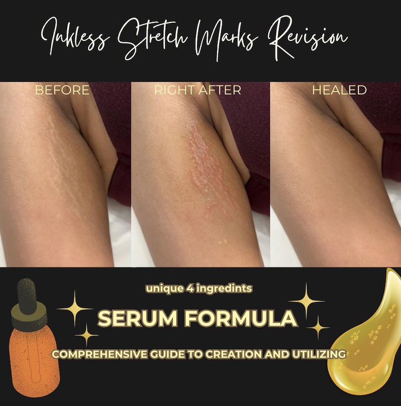May include: Image showing a before-and-after comparison of stretch marks, with the text "Inkless Stretch Marks Revision." The image includes a serum bottle and the words "SERUM FORMULA" and "COMPREHENSIVE GUIDE TO CREATION AND UTILIZING."