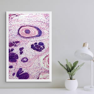 Basal Cell Carcinoma Histology Art Print
