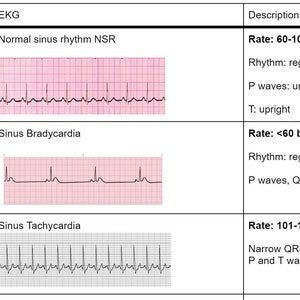 EKG Review Chart