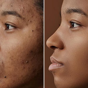 May include: Side-by-side comparison of a person's face, showing before and after skincare results. The left side displays skin with blemishes, while the right side shows smooth, clear skin. The skin tones are a warm brown against a brown background.