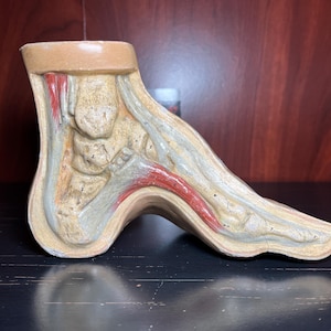 Antique 19th Century Anatomical Foot Model – German Papier Mâché with Deformity