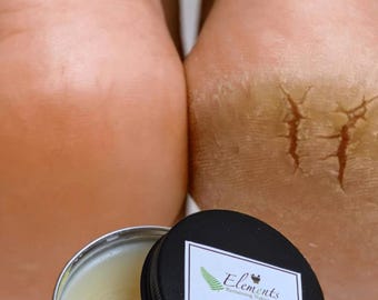 Cracked Heel & Hand Repair SALVE | All Natural Dry Skin Treatment | moisturizing | hydrating| Healing Balm by ELEMENTS