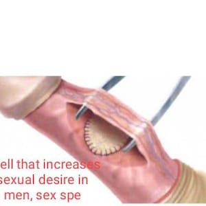 Puede incluir: Ilustración de un procedimiento médico en un pene, con instrumentos quirúrgicos y un área cosida visible. La imagen incluye el texto "Spell that increases sexual desire in men, sex spe".