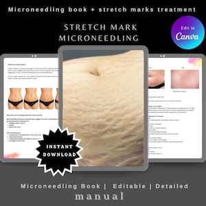 Stretch Marks Microneedling | Facial Microneedling Training Manual | 56-Page Editable Guide for Estheticians | Skin Needling Course PDF