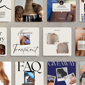May include: A set of Instagram story graphics for a scalp micropigmentation business. The graphics include images of the treatment process, before and after photos, and information about the business. The graphics are in a modern, minimalist style with a neutral colour palette.
