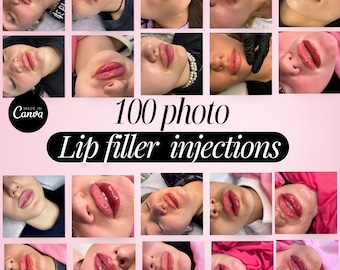 100 Lip filler Instagram post | Lip injection photo | Skincare post | Lip filler canva template, filler photo, lip filler before and after
