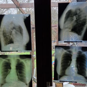 Könnte beinhalten: Vier medizinische Röntgenbilder des menschlichen Brustkorbs werden angezeigt. Zwei zeigen Seitenprofile und zwei Frontalansichten. Die Bilder sind in Grau- und Schwarztönen gehalten, wobei das Skelett und die inneren Organe sichtbar sind.