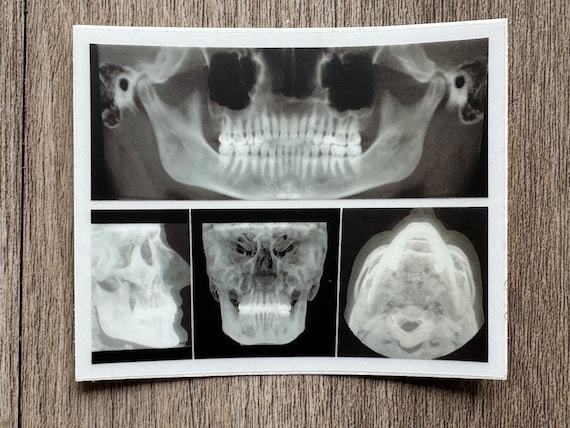 Xray The Teething Xray Baby Teething Phone X-ray Of Skull And Teeth