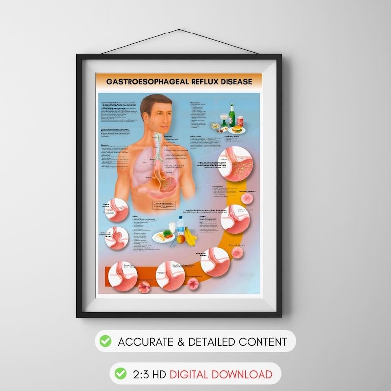 Reflü Gastroesophageal Reflux Disease Anatomy Poster (digital Download) - Etsy
