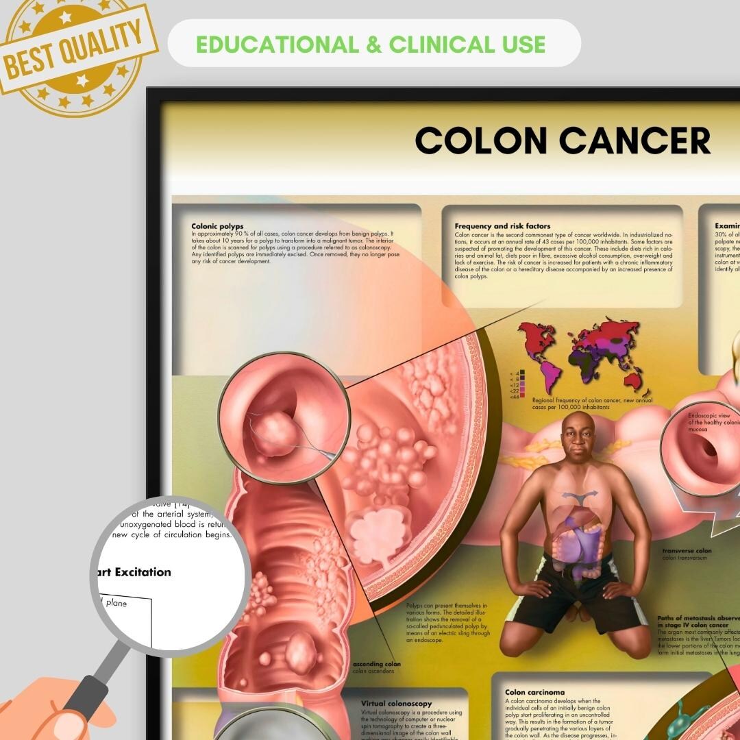 Colon Cancer Anatomy Poster, Medical Biology Print (digital Download ...