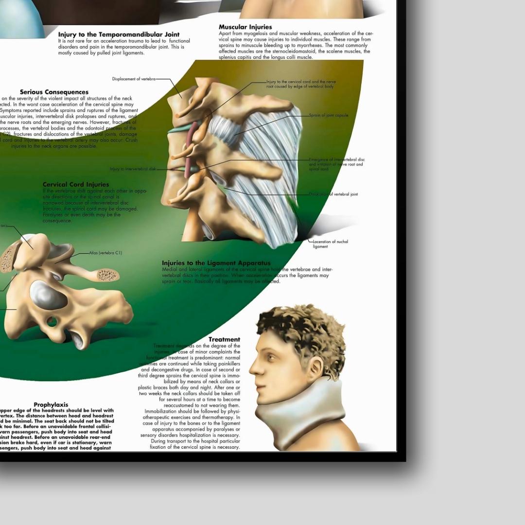 Acceleration Injury Anatomy Poster, Medical Biology Art (digital ...