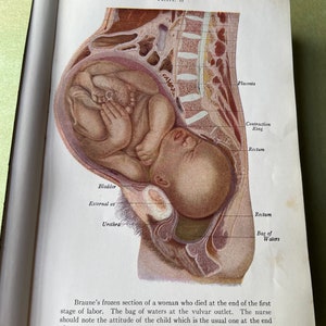 Kind Geburt 1930er Jahre Farbplatte Illustration einrahmbarer Druck für Medizinstudierende Schwangerschaft Mutterschaft Weibliche Anatomie Authentisches Original