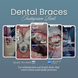 Puede incluir: Un gráfico promocional para aparatos de ortodoncia, presentado como Reels de Instagram. La imagen presenta cinco pantallas de teléfonos inteligentes que muestran información sobre aparatos de ortodoncia, con el texto "Dental Braces".