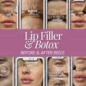 May include: A promotional image showcasing before and after results for lip filler and Botox treatments. The image features multiple smartphone screens displaying close-ups of lips, foreheads, and eyes, with text overlays highlighting the procedures and benefits.