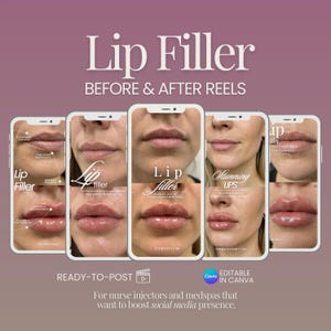 以下が含まれることがあります： リップフィラーサービスのプロモーション画像。画像には、唇のエンハンスメントのビフォーアフター写真が表示された一連のスマートフォン画面が使用されています。「Lip Filler」、「Before & After Reels」というテキストと、ソーシャルメディアへの行動喚起が含まれています。