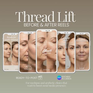 Könnte beinhalten: Werbebild für ein Fadenlifting-Verfahren, das Vorher-Nachher-Ergebnisse auf Smartphones zeigt. Der Text enthält "Thread Lift", "Before & After Reels" und "Ready to Post". Für medizinische Spas und ästhetische Kliniken.