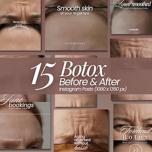 Könnte beinhalten: Eine Sammlung von 15 digitalen Instagram-Beitragsvorlagen für Botox Vorher-Nachher-Ergebnisse. Das Layout zeigt verschiedene Nahaufnahmen von Stirnen mit und ohne Falten, überlagert mit Texten wie 15 Botox Before & After, Ready for a transformation, Smooth skin at your fingertips, Lines smoothed und Forehead Botox.