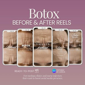 Botox Vorher & Nachher Reels: Medspa Instagram Templates (Digitaler Download)