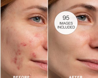 Acne Stock Photo Bundle | Authentic Skincare Images (Digital Download)