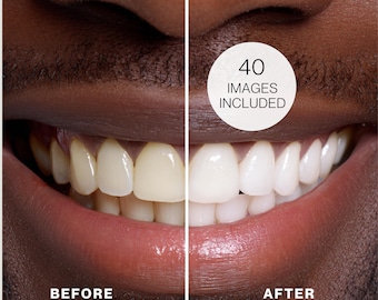 Teeth Whitening vor und nach bestand Fotos | Zahnmedizin (PNG Digital Download)