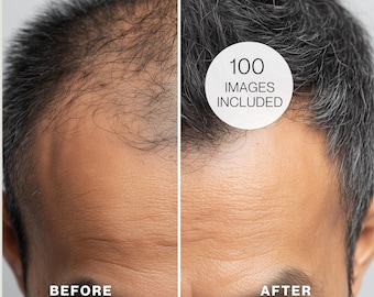 Hair Growth Before & After Photos | Clinic Stock Images (Digital Download)