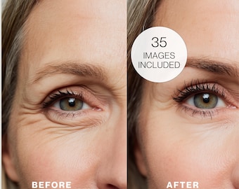 Botox Treatment Before and After Stock Photos | Skincare Medspa Images (Digital Download)