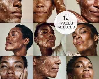 Vitiligo Stock Photos | Skincare & Wellness Images (Digital Download)