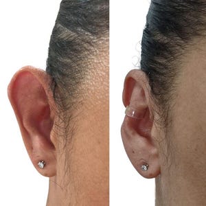 Puede incluir: Comparación del antes y el después de una oreja. El lado izquierdo muestra una oreja prominente, mientras que el lado derecho muestra la oreja con un dispositivo de corrección de oreja claro y curvado. Ambas orejas tienen un pequeño pendiente de plata.