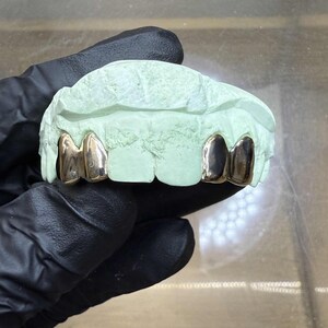 Puede incluir: Un molde dental verde claro con dos fundas dentales doradas. Las fundas son brillantes y reflejan la luz. El molde est&aacute; sujeto por una mano enguantada.