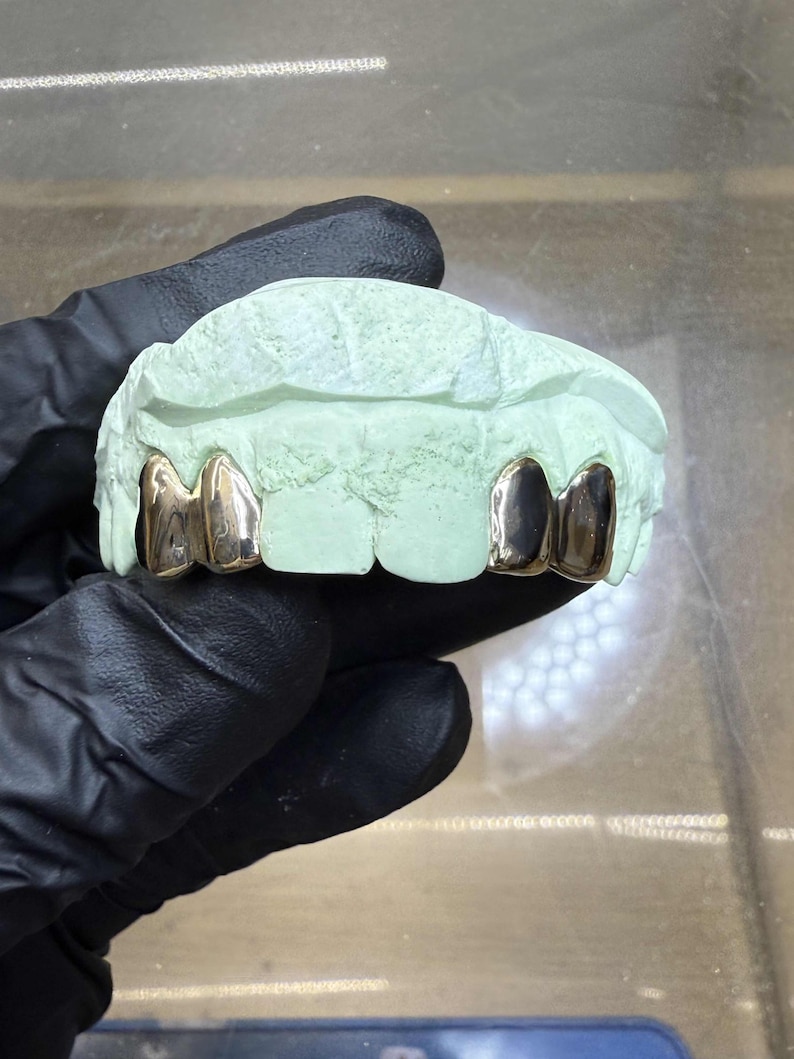 Puede incluir: Un molde dental verde claro con dos fundas dentales doradas. Las fundas son brillantes y reflejan la luz. El molde est&aacute; sujeto por una mano enguantada.
