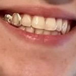 May include: A close-up of a person's smile, showcasing a silver dental crown on a tooth. The teeth are white and well-aligned, with the lips slightly parted. The skin tone is fair, and the overall image suggests dental health and care.