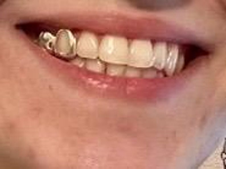 May include: A close-up of a person's smile, showcasing a silver dental crown on a tooth. The teeth are white and well-aligned, with the lips slightly parted. The skin tone is fair, and the overall image suggests dental health and care.