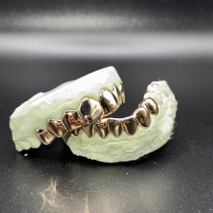 Puede incluir: Un juego de fundas dentales color oro ajustadas sobre un molde dental de yeso verde p&aacute;lido. Las cubiertas met&aacute;licas para los dientes est&aacute;n pulidas y son reflectantes, mostrando los contornos de las arcadas dentales superior e inferior.
