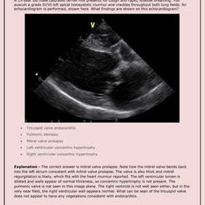 Puede incluir: Una imagen de ecografía en blanco y negro del corazón de un perro. La imagen muestra la válvula mitral, el ventrículo izquierdo y el ventrículo derecho. El texto en la imagen dice: "Endocarditis de la válvula tricúspide", "Estenosis pulmonar", "Prolapso de la válvula mitral", "Hipertrofia concéntrica ventricular izquierda", "Hipertrofia concéntrica ventricular derecha".
