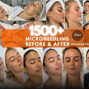 Microneedling Before  After | Esthetician IG Template | Facial & RF Microneedling Post Templates | Spa Social Media Content