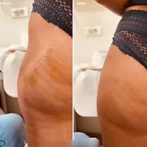 Sculptra Training, BBL, Injections, Butt Filler, Non Surgical Bbl ...