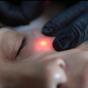 Op de afbeelding: Close-up van iemands gezicht dat een rode lichtbehandeling krijgt. Een hand met een handschoen houdt een apparaat vast dat rood licht uitstraalt op de wang van de persoon.