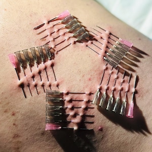 May include: A close-up of a person's skin with multiple needles inserted in a starburst pattern. The needles are clear with pink caps.